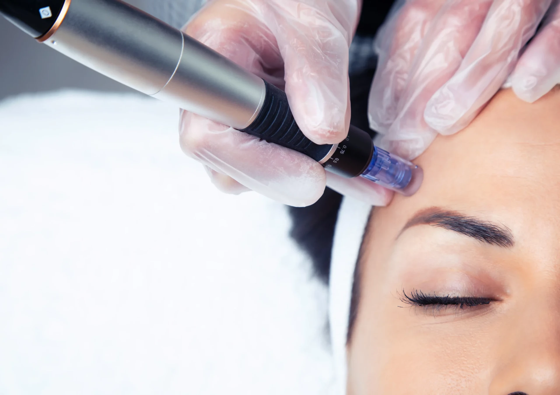 Microneedling behandling hos Carinas Hudvård